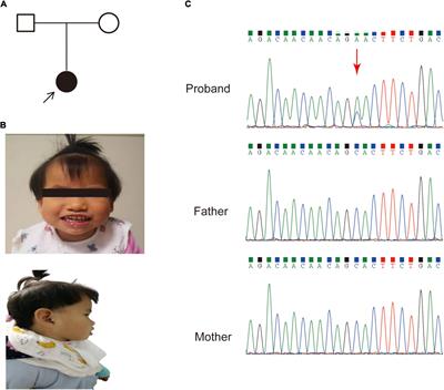 Whole-genome sequencing combined RNA-sequencing analysis of patients with mutations in SET binding protein 1